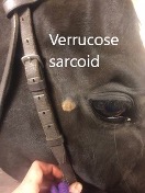 Verrucose Sarcoid